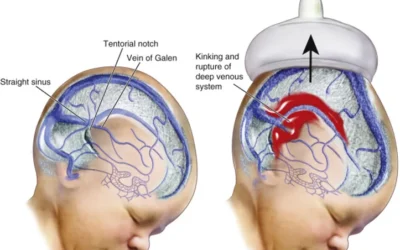 Intracranial Hemorrhage in Newborns: Navigating Challenges with Expert Care at New Born Care